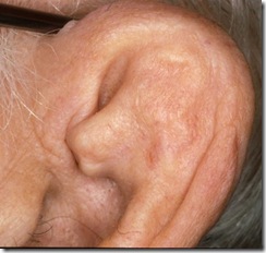 pinna celulitis emedicina diabetes pinna celulitis emedicina diabetes